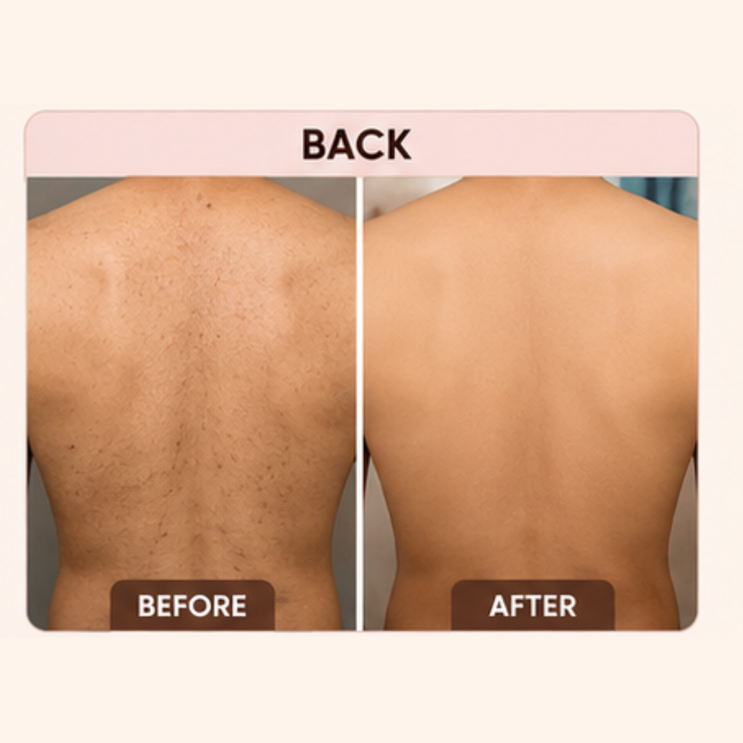 Before and after comparison of a person's back with hair removal treatment.